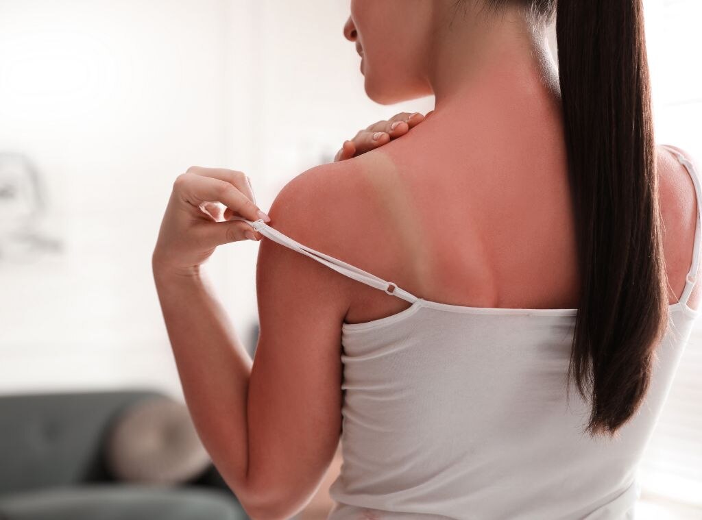 sunburn hero image.jpg